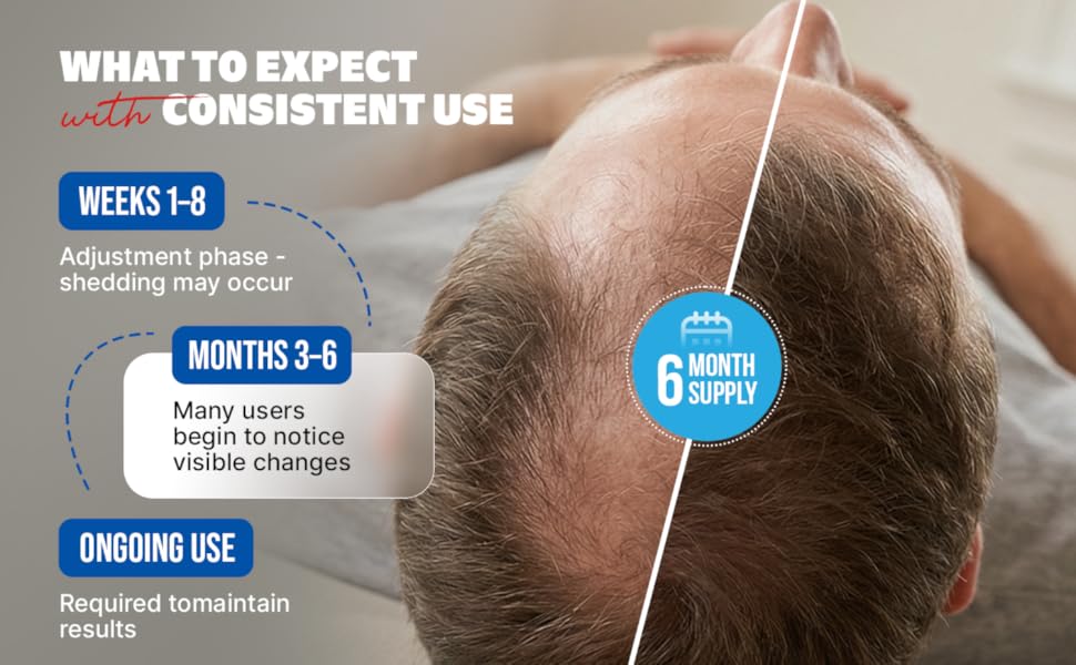 Kirkland Minoxidil 5% Topical Solution for Men with Dropper Applicator, 6-Month Supply